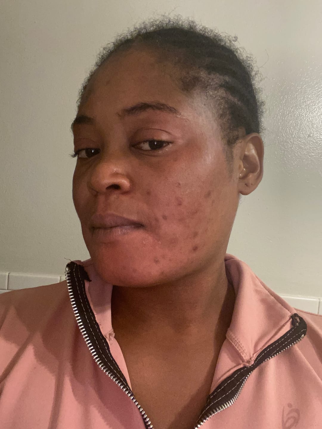 Customer photo review of NEW Redness and Burn Face Cream