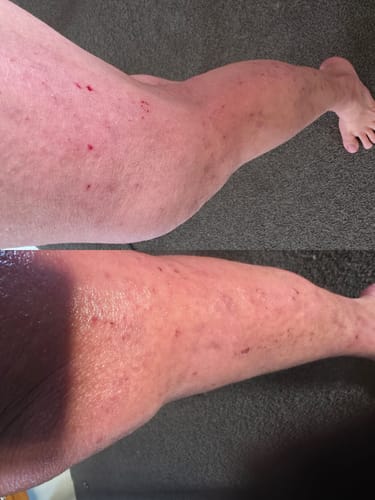 Customer photo review of Eczema Scratch Mitten