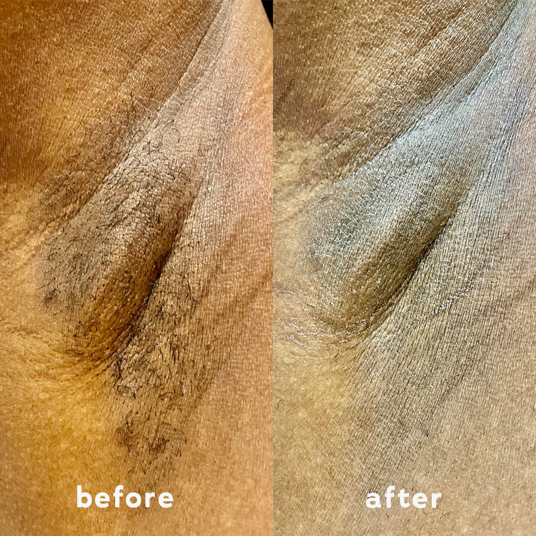 Customer photo review of Dermave™ Electric Trimmer 2.0