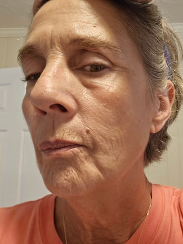 Customer photo review of 3 Month Supply - Seranova Micro Infusion System