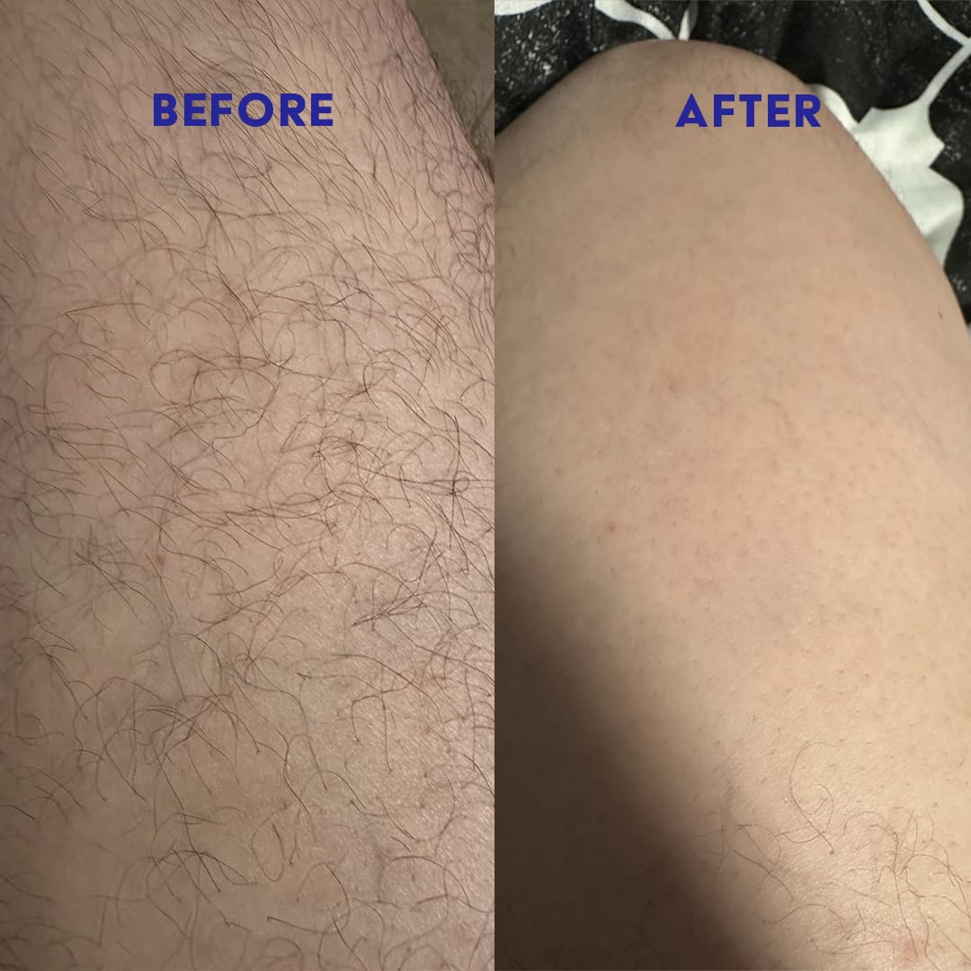 Customer photo review of Dermave™ Electric Trimmer 2.0