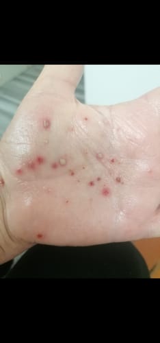 Customer photo review of SERENI Pikkelysömör és Ekcéma Krém