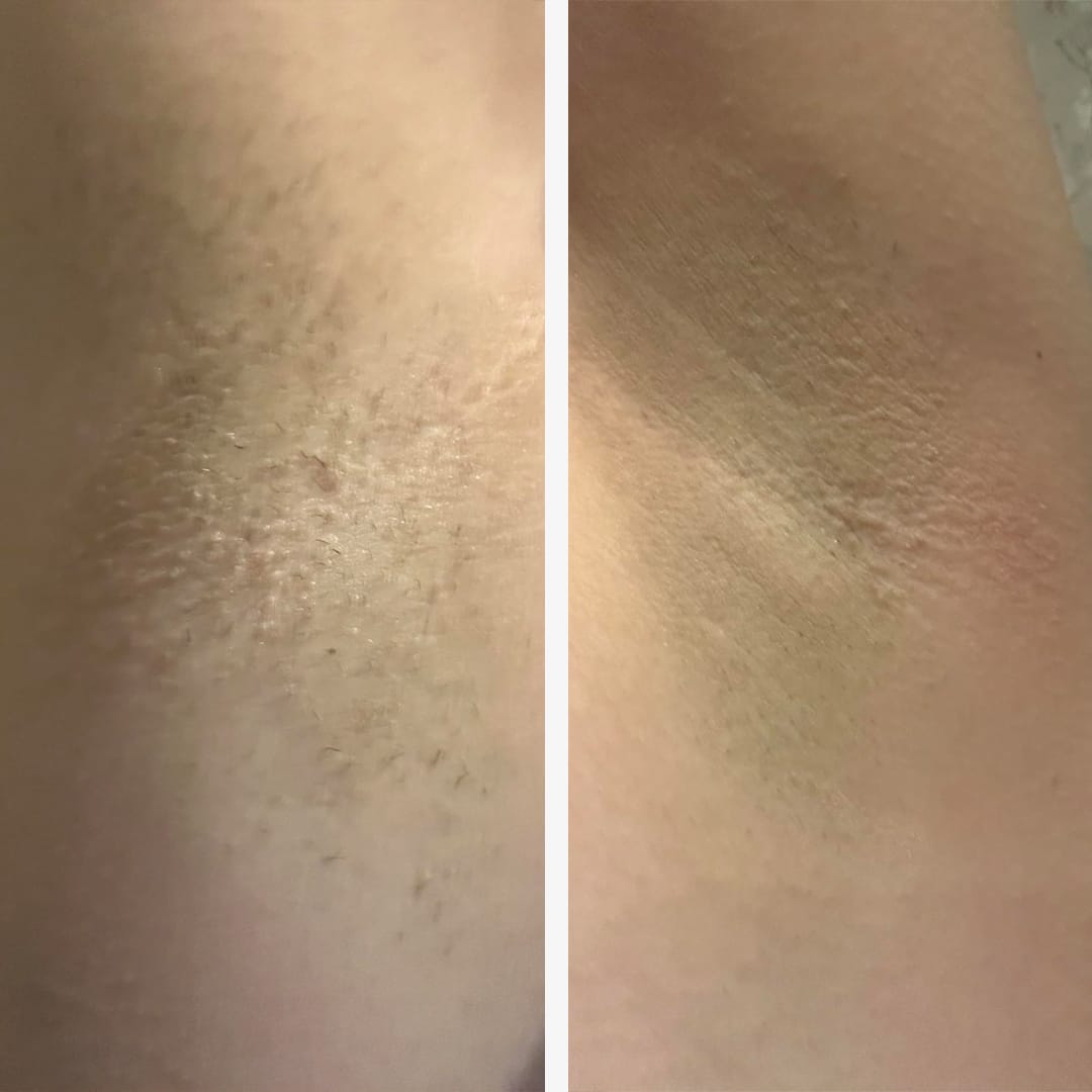 Customer photo review of Dermave™ Electric Trimmer 2.0