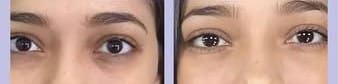 Customer photo review of Eye Roller | Eliminates Dark Circles & Puffy Eyes