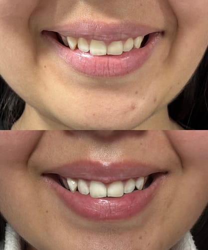 Customer photo review of Tiras Blanqueadoras Dentales VITTÉ | Tratamiento 14 días