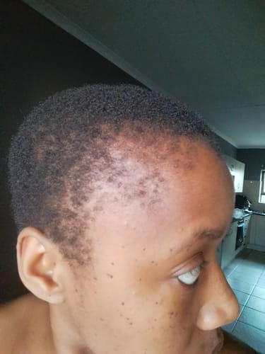 Customer photo review of Hairline Fortifying Serum 30ml - Minoxidil