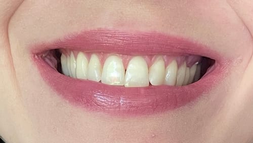 Customer photo review of Tratamiento VITTÉ 14 días