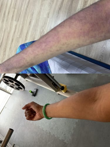 Customer photo review of Eczema Scratch Mitten