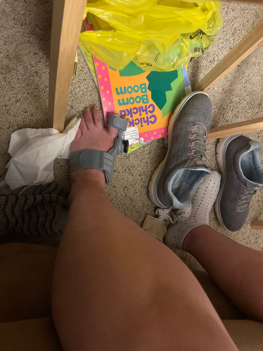 Customer photo review of Treatmedy™ Bunion Fix - Natural At-Home Bunion Relief