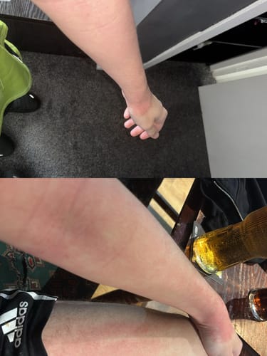Customer photo review of Eczema Scratch Mitten