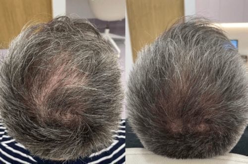 Customer photo review of Cactevo hair Growth Premium Serum