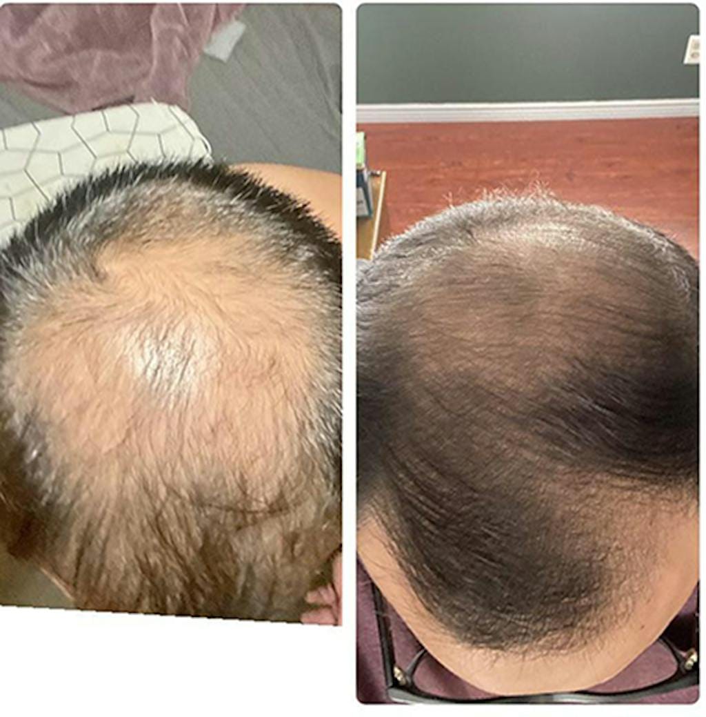 Customer photo review of Cactevo hair Growth Premium Serum