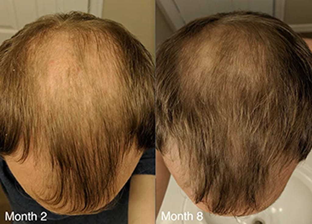 Customer photo review of Cactevo hair Growth Premium Serum