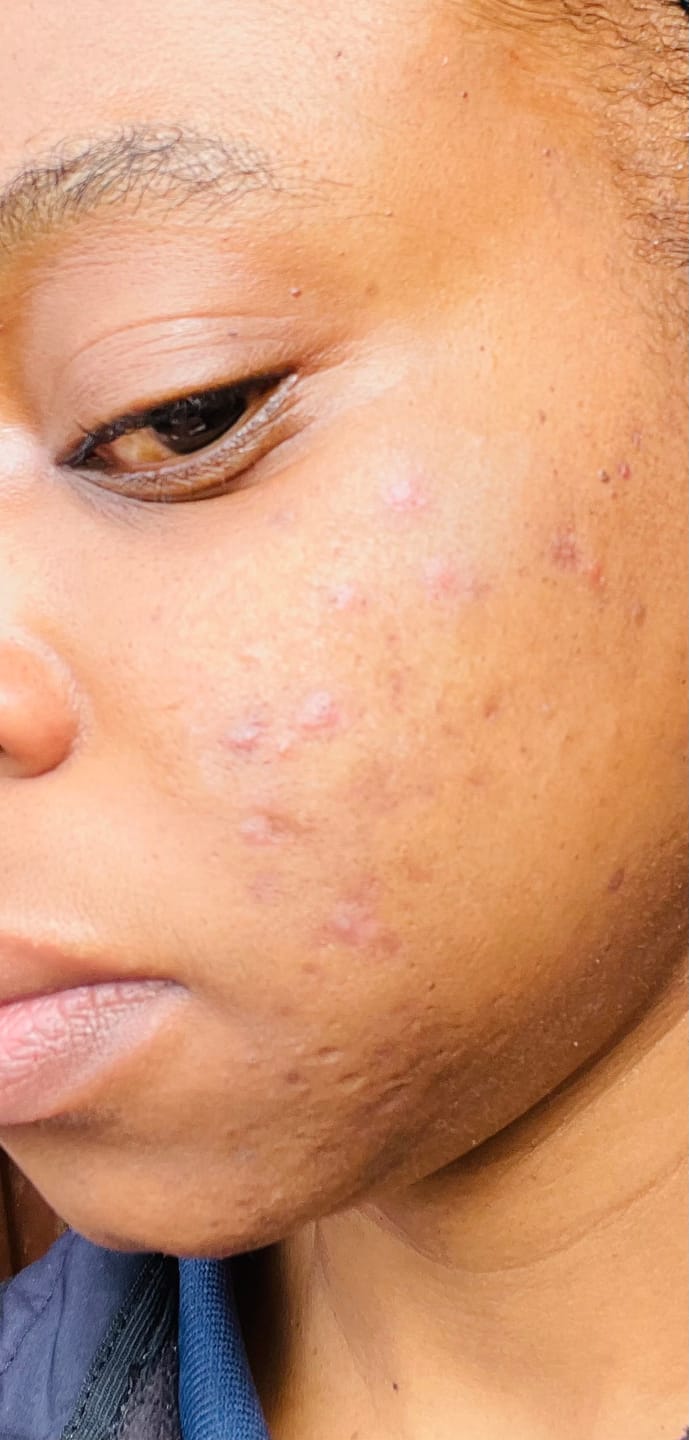 Customer photo review of Gmaeum Acne Capsules (3 Months Supply)