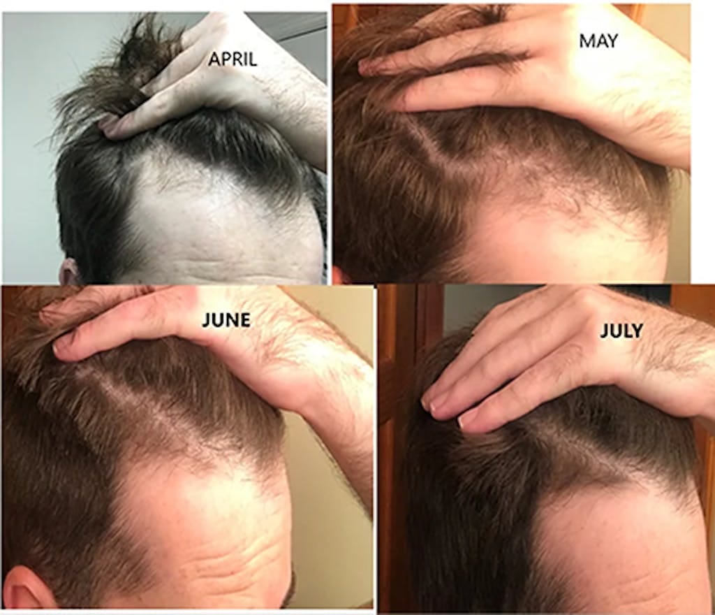 Customer photo review of Cactevo hair Growth Premium Serum