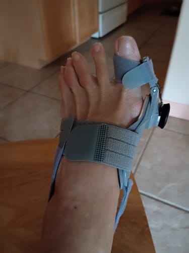 Customer photo review of Treatmedy™ Bunion Fix - Natural At-Home Bunion Relief