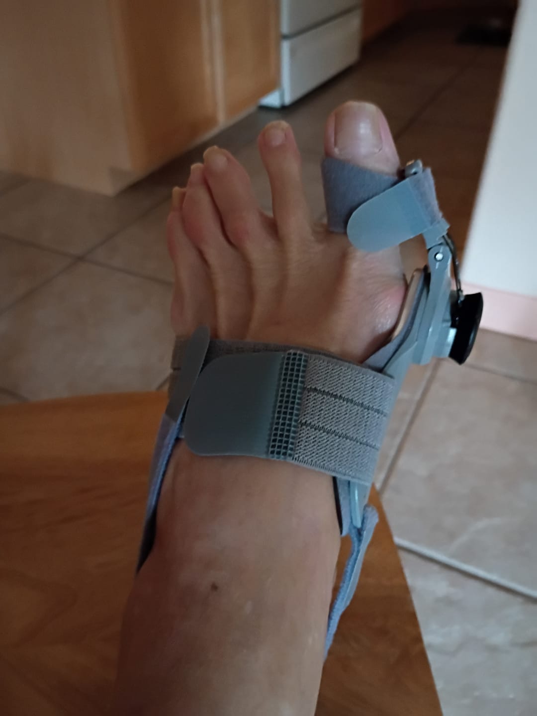 Customer photo review of Treatmedy™ Bunion Fix - Natural At-Home Bunion Relief