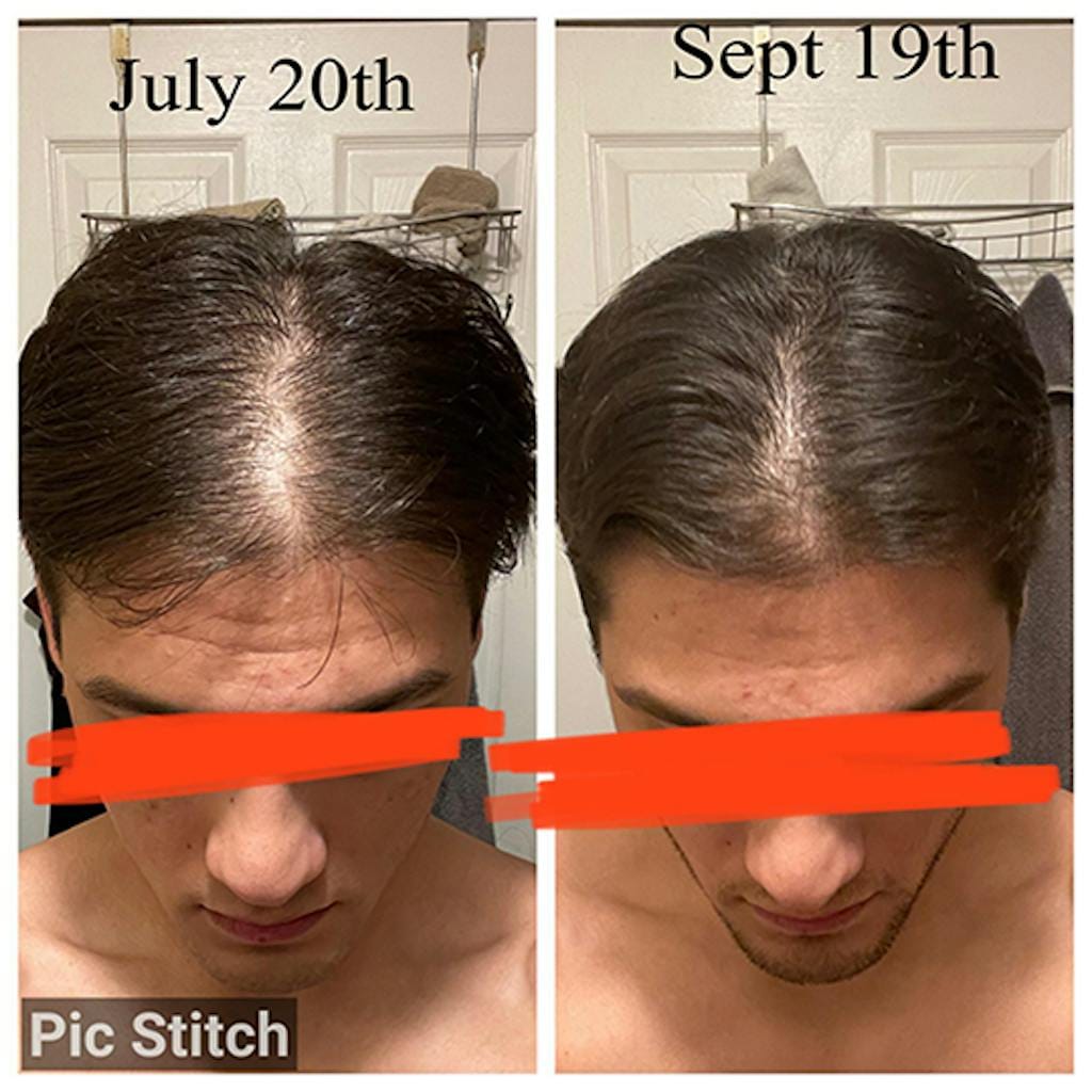 Customer photo review of Cactevo hair Growth Premium Serum