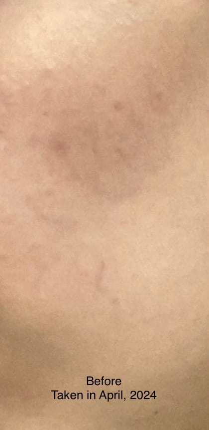 Customer photo review of MandelAC Serum