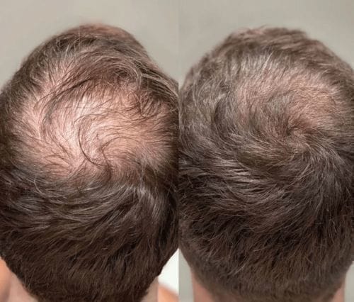 Customer photo review of Cactevo hair Growth Premium Serum