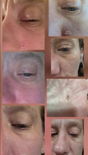 Customer photo review of LumiClear™ – Removedor de Verrugas Avanzado