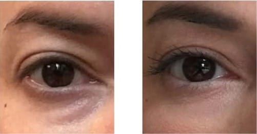 Customer photo review of Eye Roller | Eliminates Dark Circles & Puffy Eyes