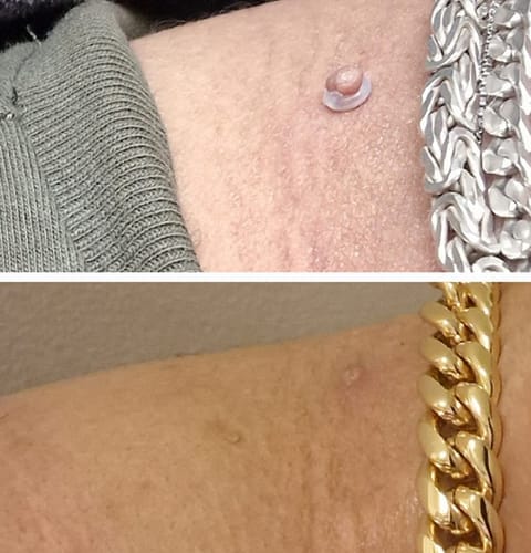 Customer photo review of LumiClear™ – Removedor de Verrugas Avanzado
