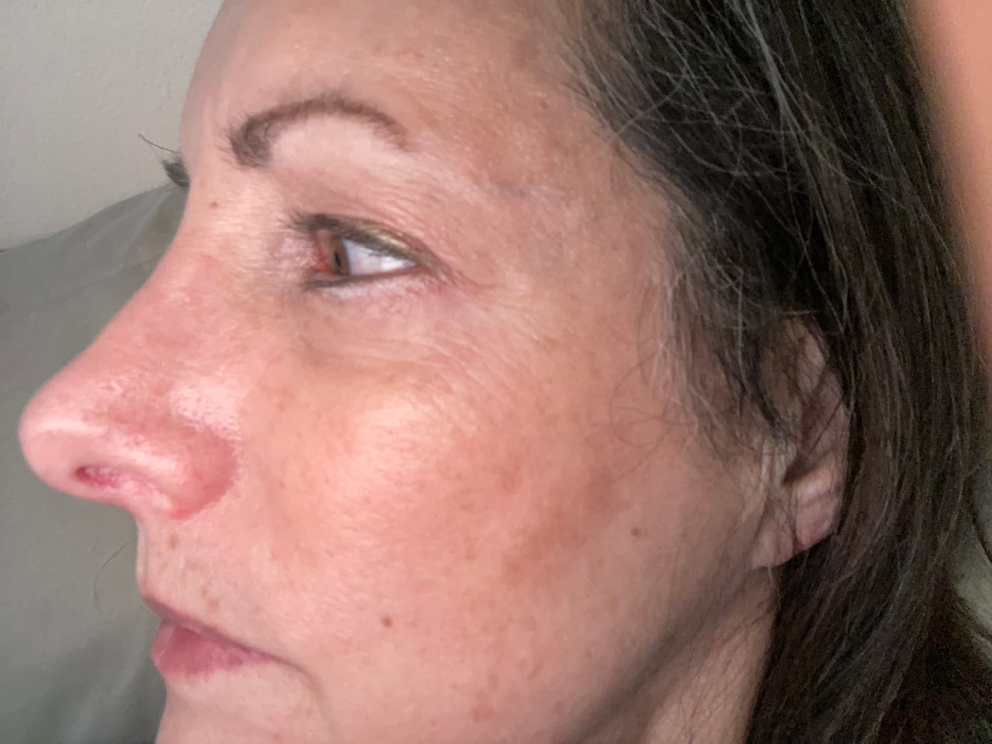 Customer photo review of Glov Serum-Infused Microneedle Eye Patches
