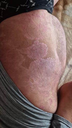 Customer photo review of SERENI Pikkelysömör és Ekcéma Krém