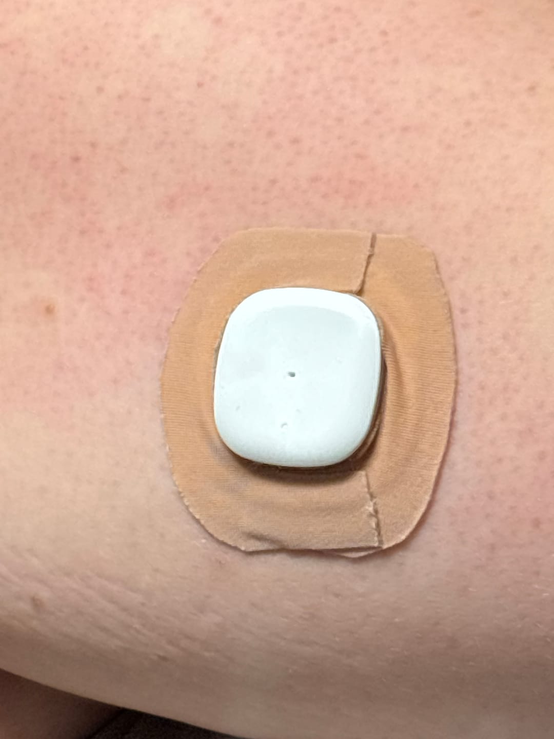 Customer photo review of Tape Roll – Tryggt fäste för CGM-sensorer och pumpar