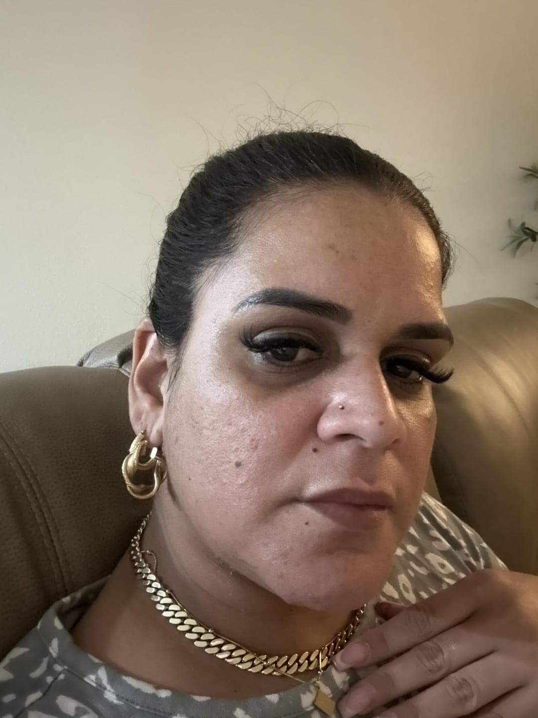 Customer photo review of Prandest Arbutin 7% + Tranexamic Acid 4% Cream