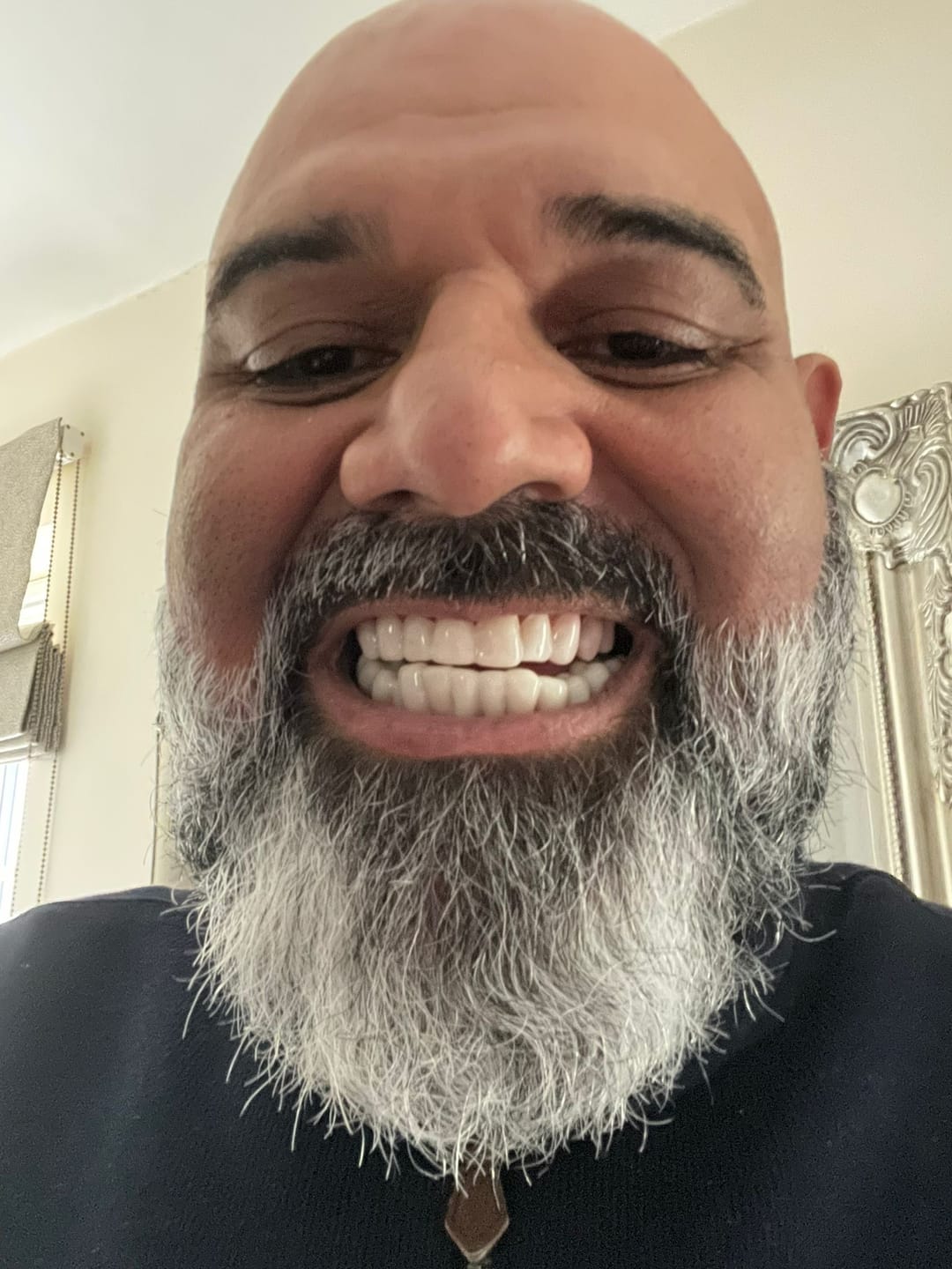 Customer photo review of Click-in Veneers 4.0