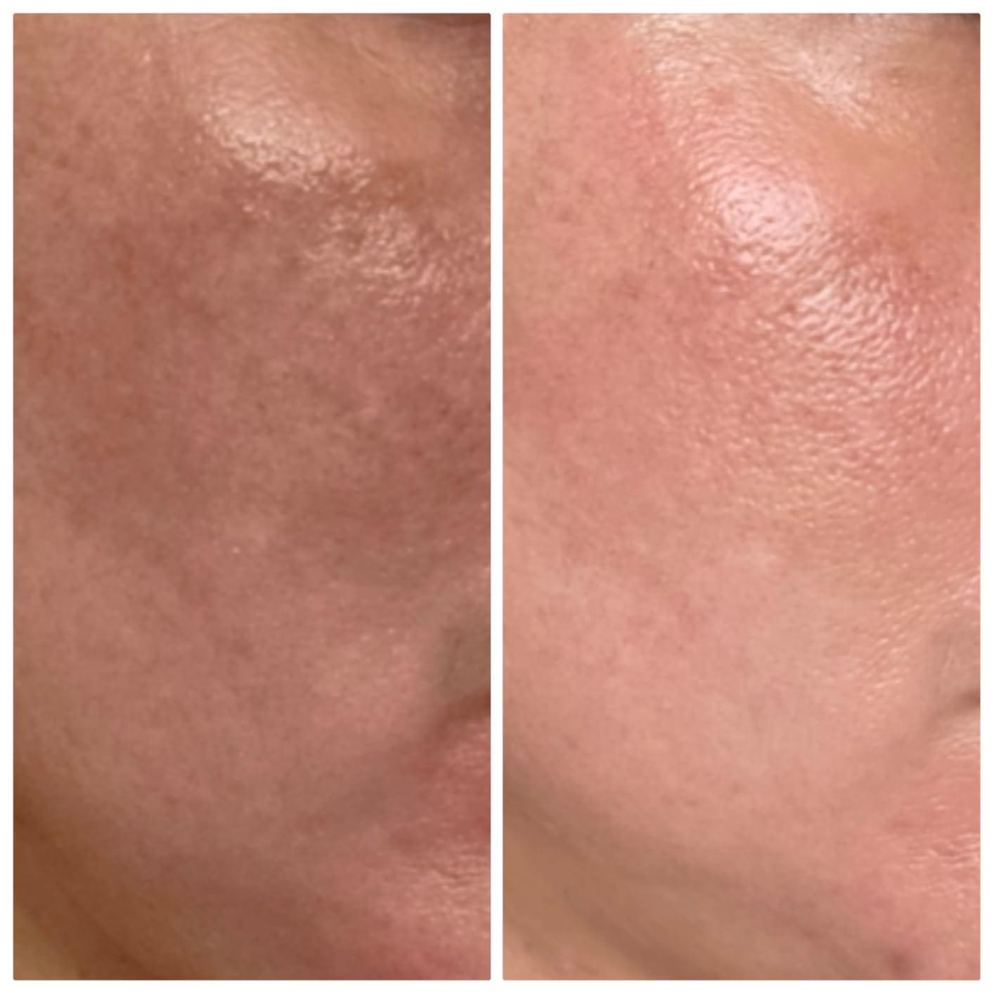 Customer photo review of Prandest Arbutin 7% + Tranexamic Acid 4% Cream