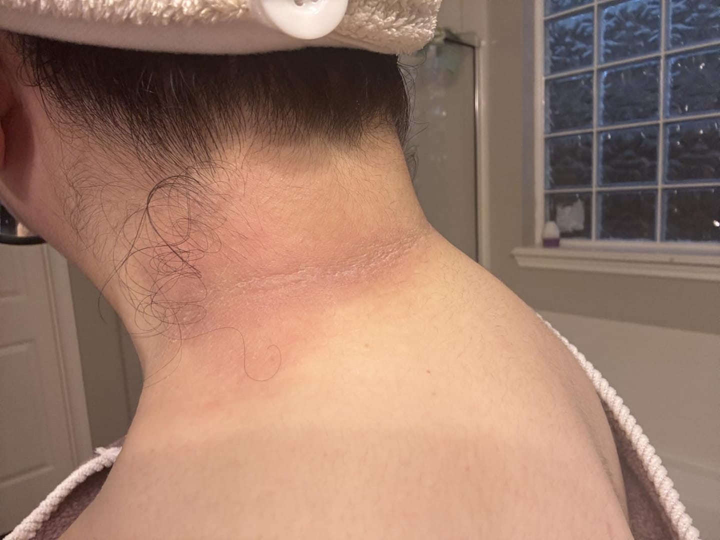Customer photo review of Prandest Arbutin 7% + Tranexamic Acid 4% Cream