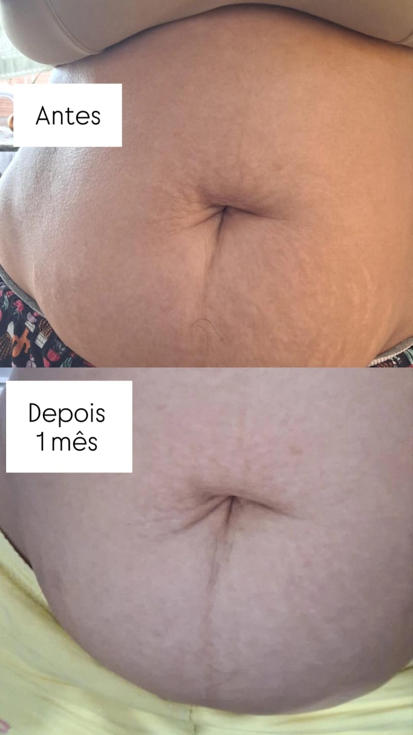 Customer photo review of Daily Tratamento - Creme Para Estrias