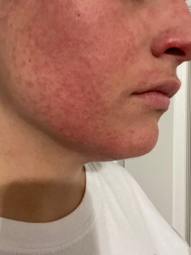 Customer photo review of All Over Ointment Eczema Treatment