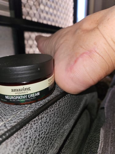 Customer photo review of Neuropathy Nerve Relief Cream