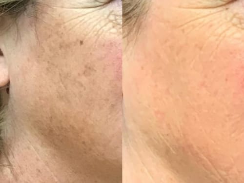 Customer photo review of Labbok Skin Lightening Cream, 30ml