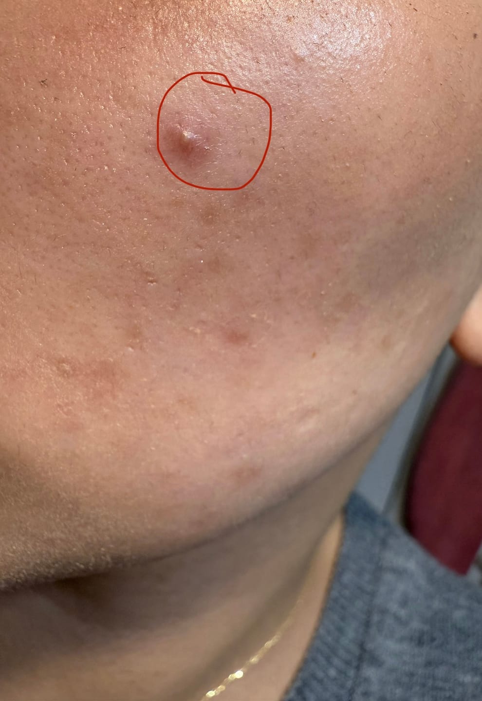 Customer photo review of Brave Skin - Patches de jour et de nuit contre l'acné