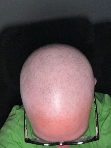 Customer photo review of Chemo Cream for Scalp