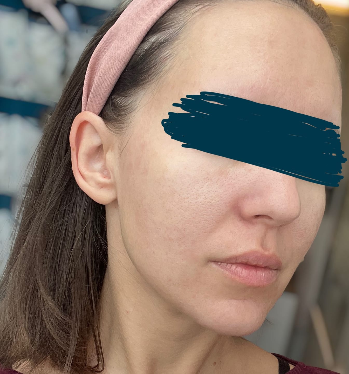 Customer photo review of Porenfeines 4% BHA PEELING