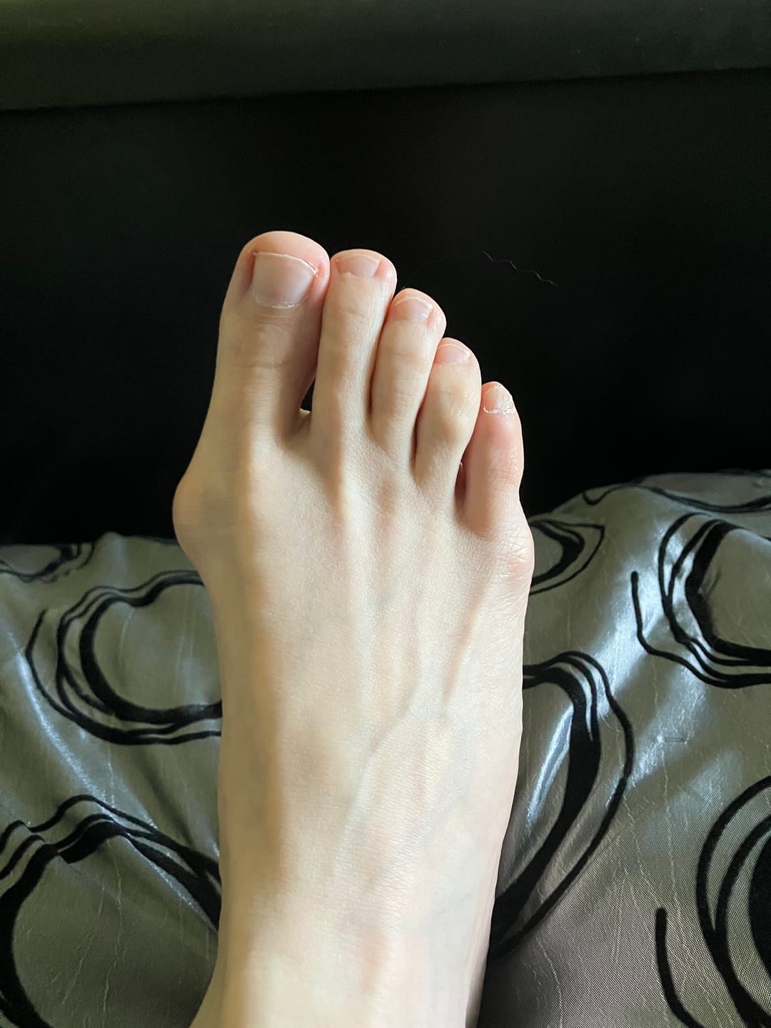 Customer photo review of Treatmedy™ Bunion Fix - Natural At-Home Bunion Relief