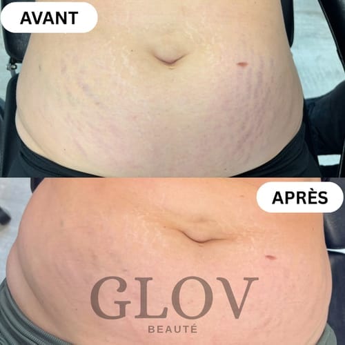 Customer photo review of Glov Beaute Stretch Mark Kit