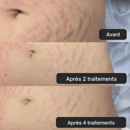 Customer photo review of Glov Beaute Stretch Mark Kit