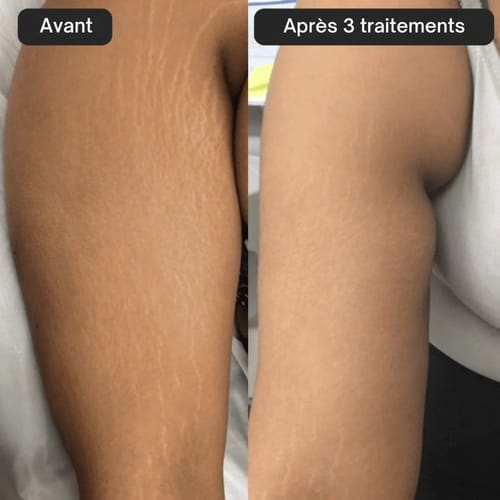 Customer photo review of Glov Beaute Stretch Mark Kit