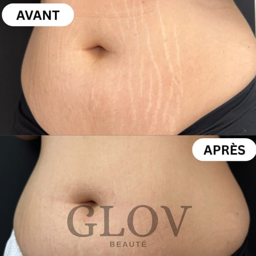 Customer photo review of Glov Beaute Stretch Mark Kit