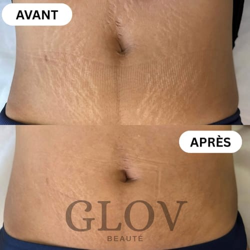 Customer photo review of Glov Beaute Stretch Mark Kit