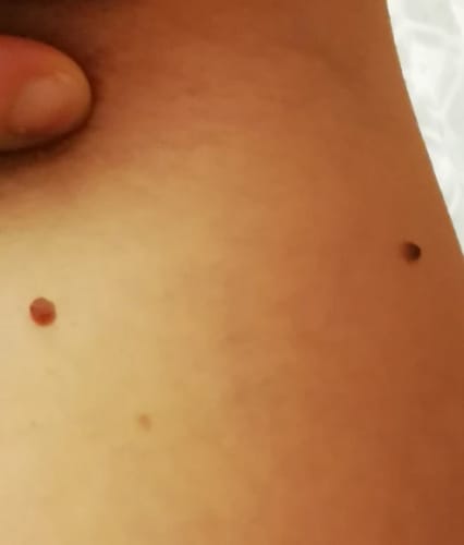 Customer photo review of ערכה להסרת תגי עור SkinTagGone™