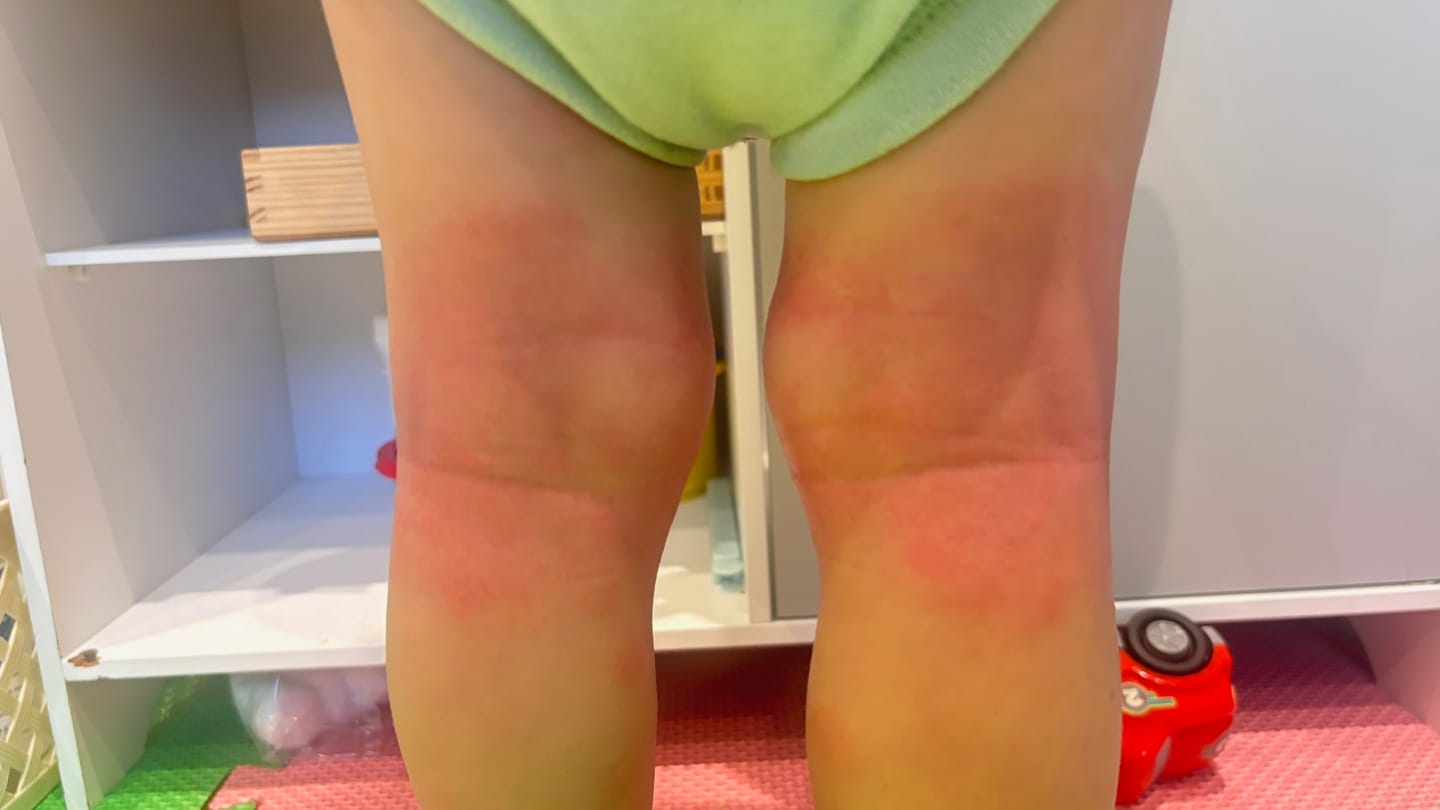 Customer photo review of Large Bioskin Duo Pack