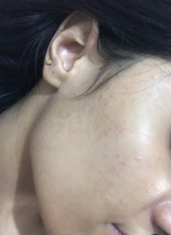 Customer photo review of MandelAC Cream